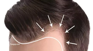 زراعة الشعر | تعقب